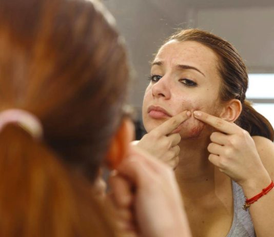 Stages of acne